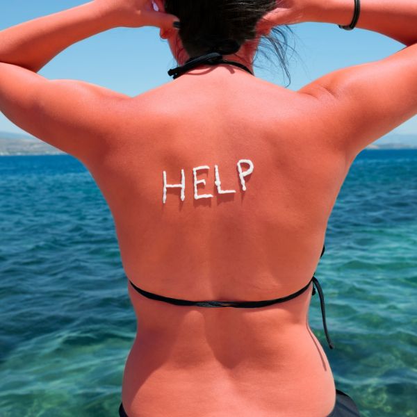 How to Soothe Your Worst Sunburn  