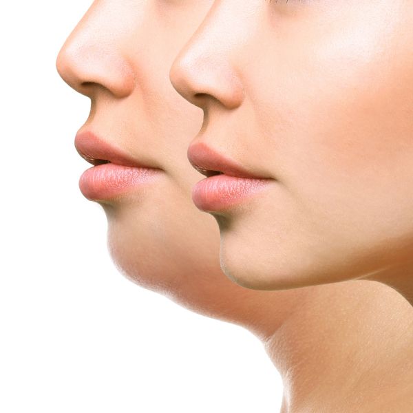 How to get rid of saggy chin and neck sale